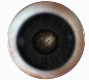 Posterior Subcapsular Cataract