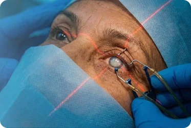 Close-up image of cataract eye showing cloudy lens before surgery in Bahawalpur