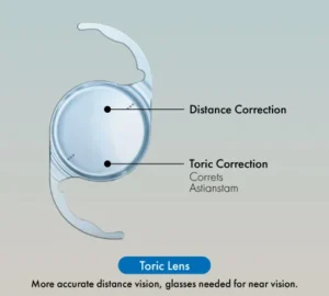 Toric Lenses clears Astigmatism